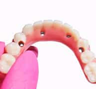implantes